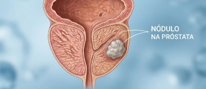 ca de próstata gemini