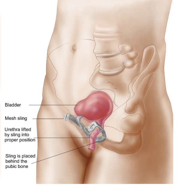 sling ou tela para incontinência urinária